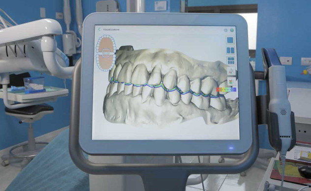 BV Lab produzione dispositivi odontoiatrici su misura da scansioni intraorali